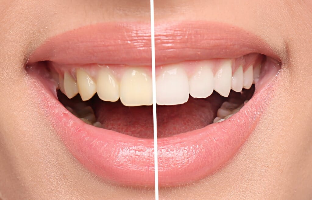 zoom teeth whitening process